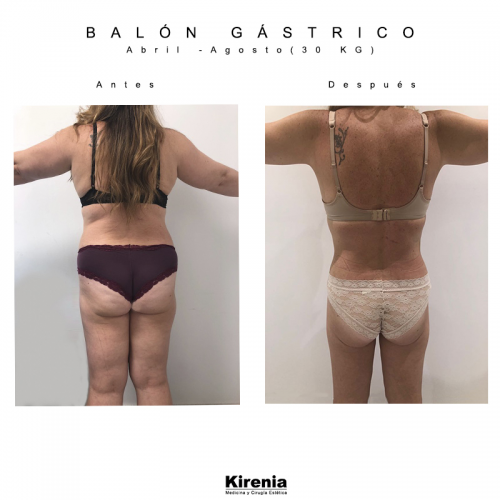 Bal�n g�strico 5 meses
